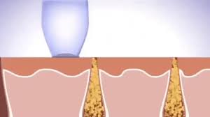Blackheads™ - Pelle Liscia e Vellutata
