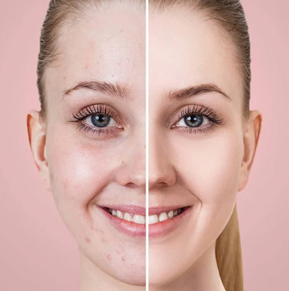 Blackheads™ - Pelle Liscia e Vellutata